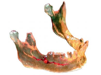 3D model of a lower jaw in stereolithography, photo: caesar